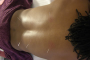 acupuncture